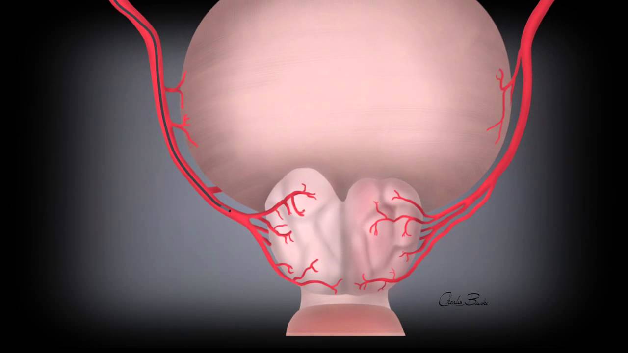 prostatic artery embolization Jerusalem